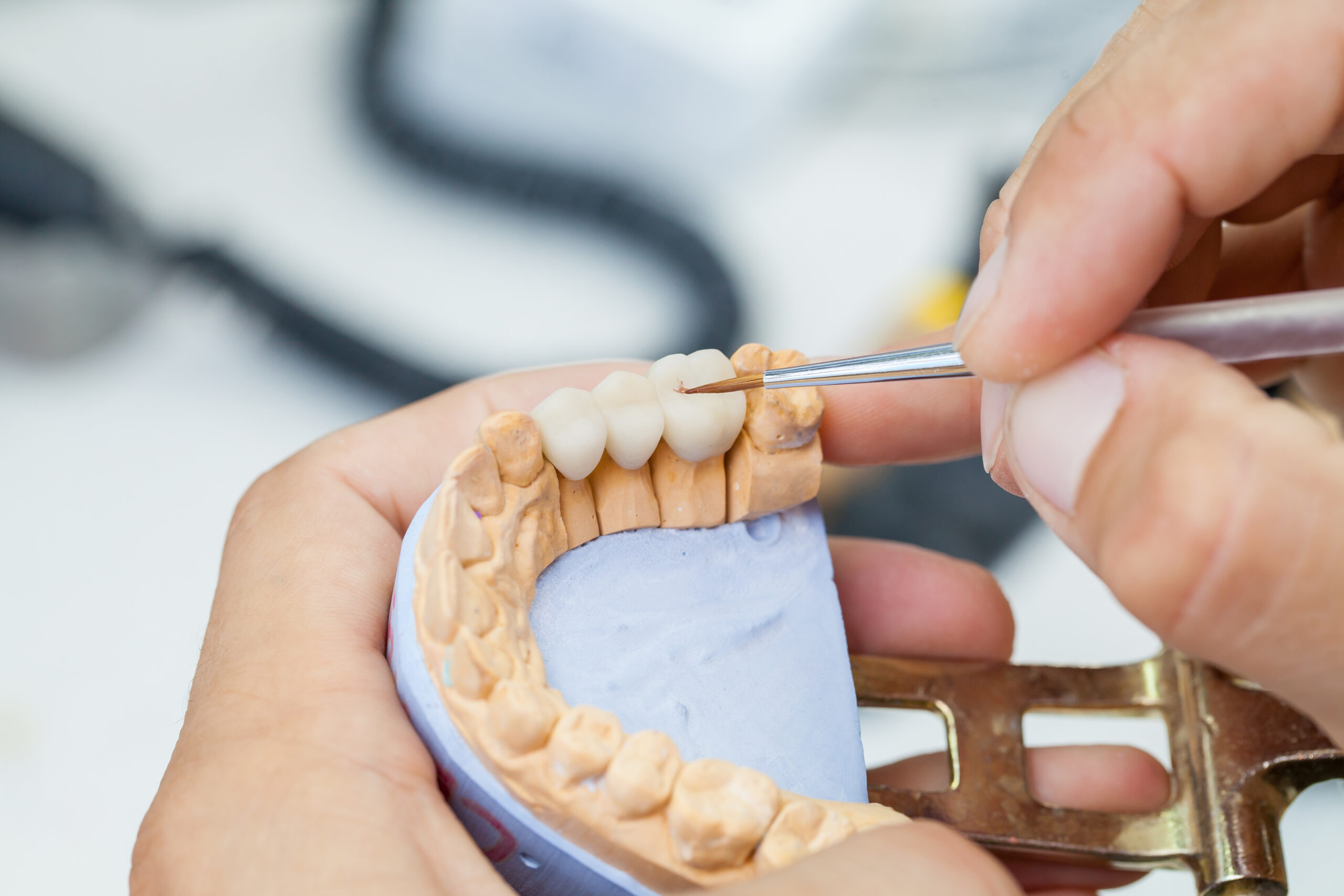 pros and cons of a dental bridge for your missing tooth